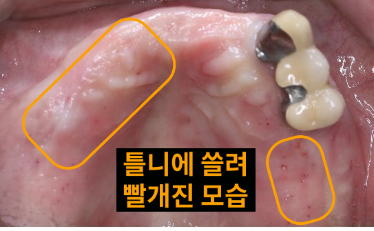 내원 시 구강 내부, 70대 여성(2024/09 촬영)
