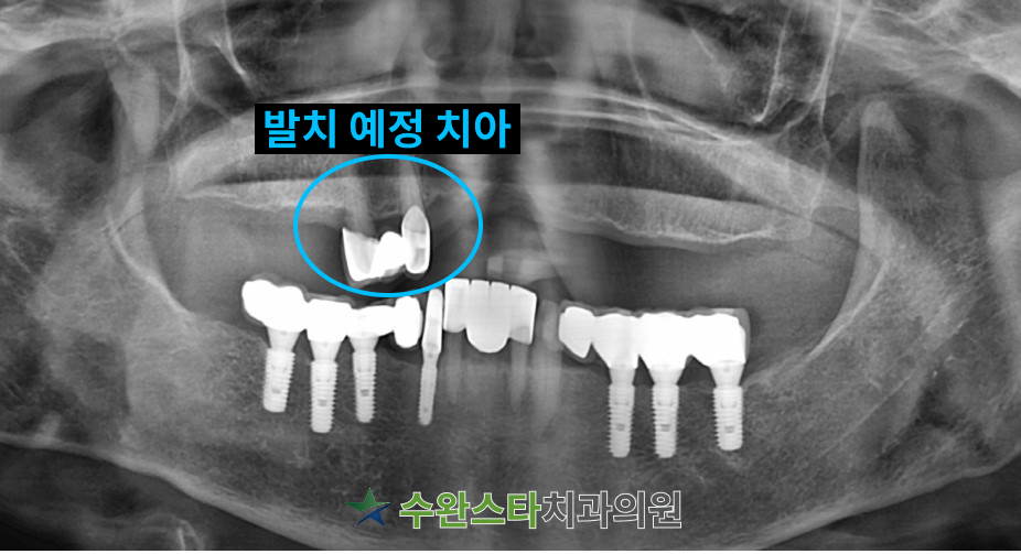 내원 시 파노라마, 70대 여성(2024/09 촬영)