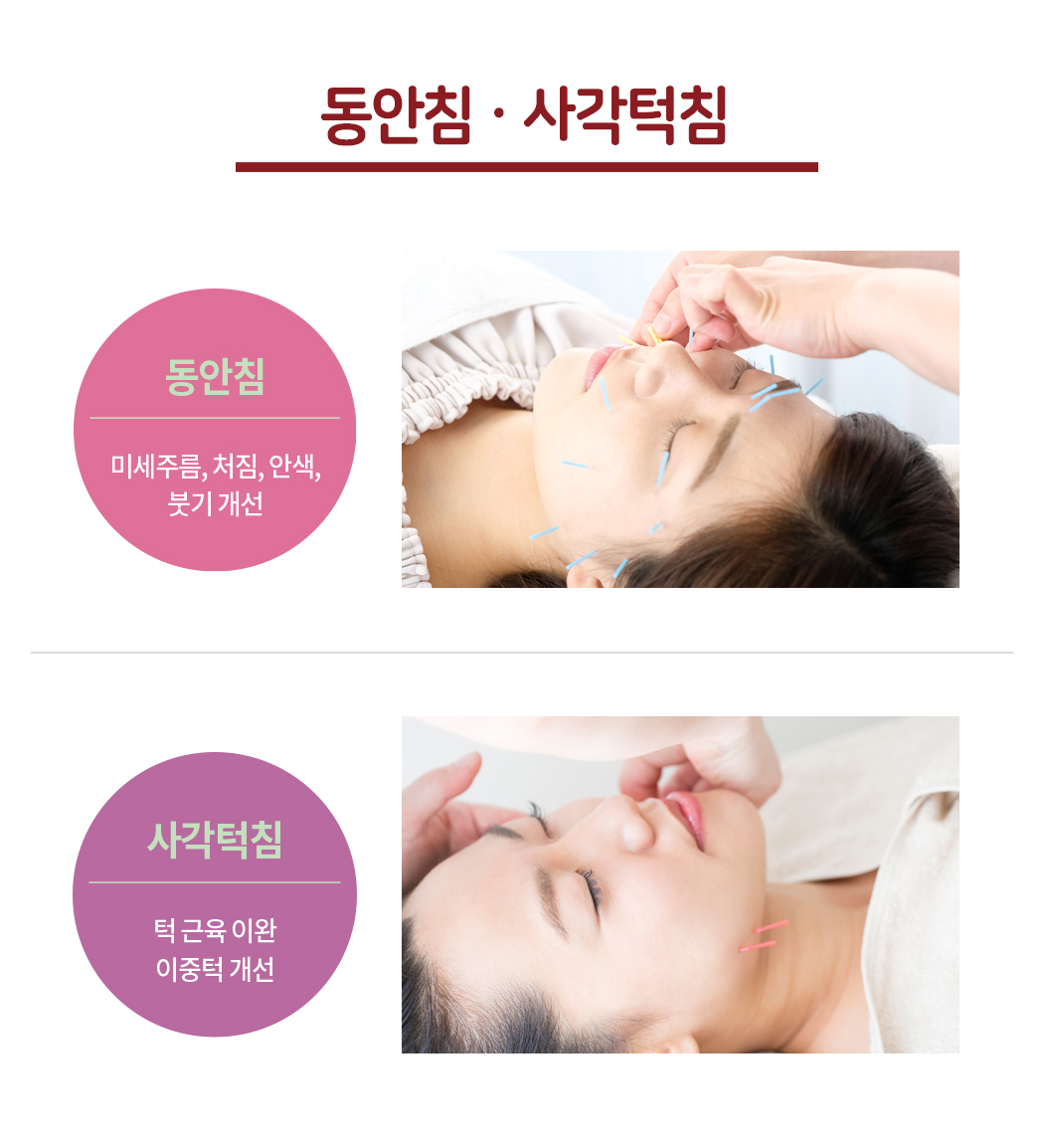 대한민국365한의원_안면침(동안침), 사각턱침