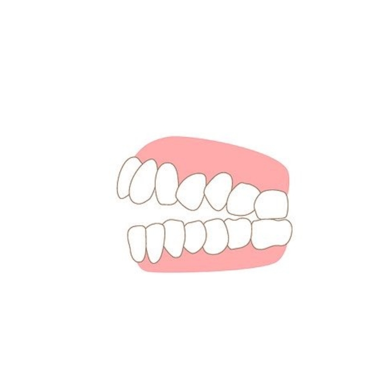 <p style="margin-left:10px;"></p><h5 style="margin-left:5px">개방교합(앞니 닿지 않음)</h5>