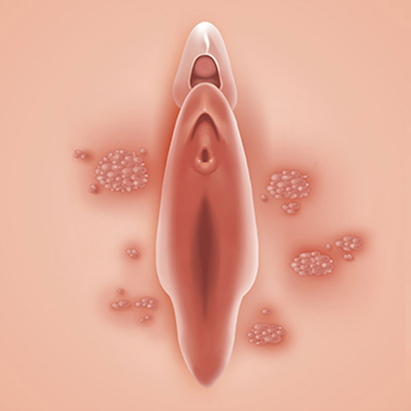 Condyloma Acuminatum