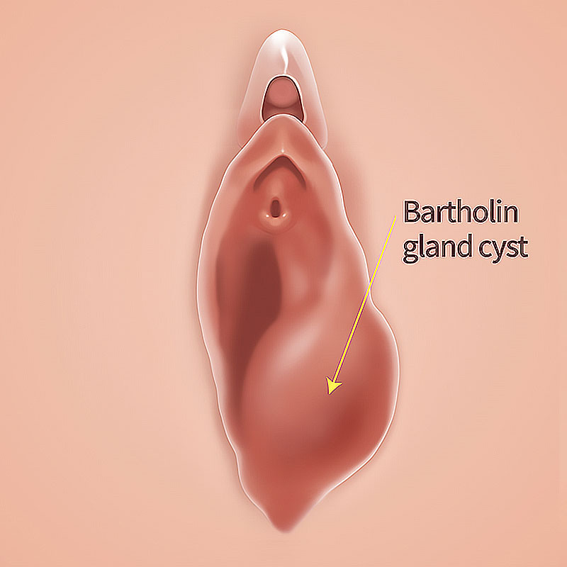 Bartholin’s Cyst