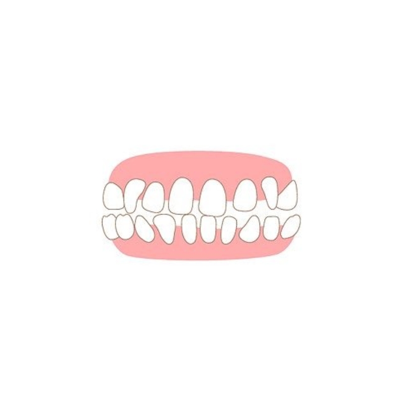 <p style="margin-left:10px;"></p><h5 style="margin-left:10px">치아벌어짐</h5>