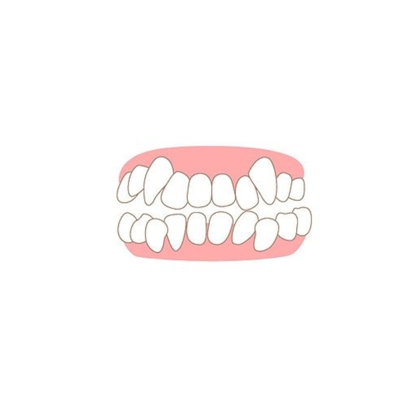 <p style="margin-left:10px;"></p><h5 style="margin-left:10px">심한덧니</h5>