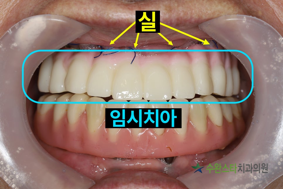 수술 2일 후 임시치아, 60대 여성 (2025.4 촬영)
