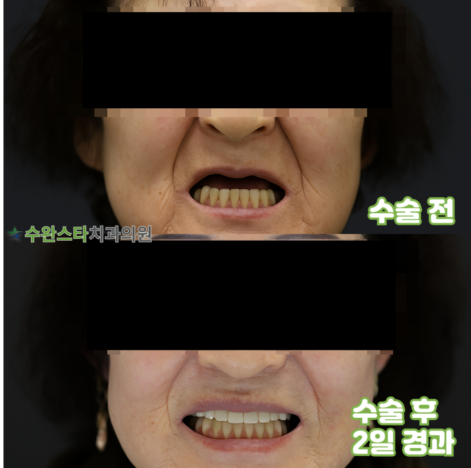수술 전, 수술 후 2일 경과, 60대 여성 (2025.4촬영)