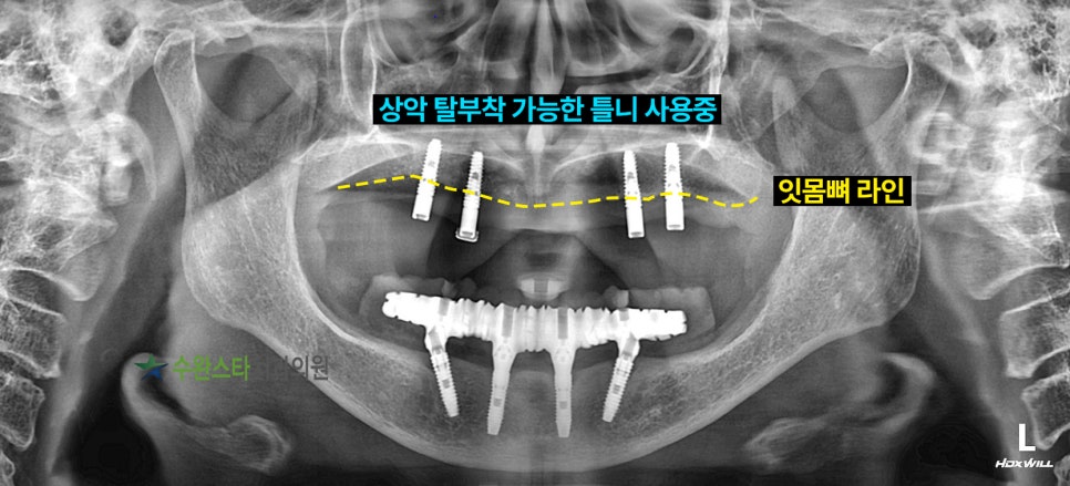 내원 시 구강 파노라마, 60대 여성 (2025.4 촬영)