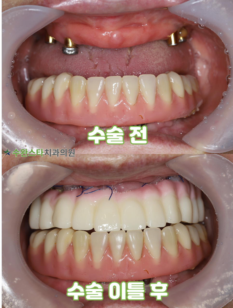 수술 전 / 수술 2일 후 구강 내부, 60대 여성 (2025.4촬영)