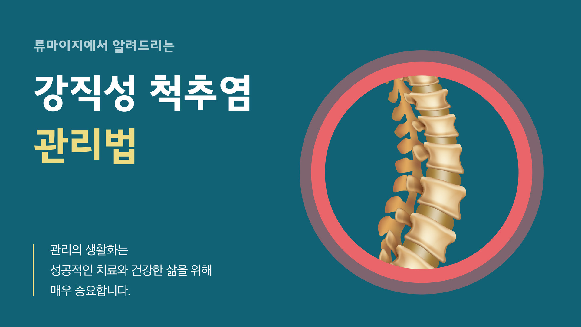 강직성척추염관리 