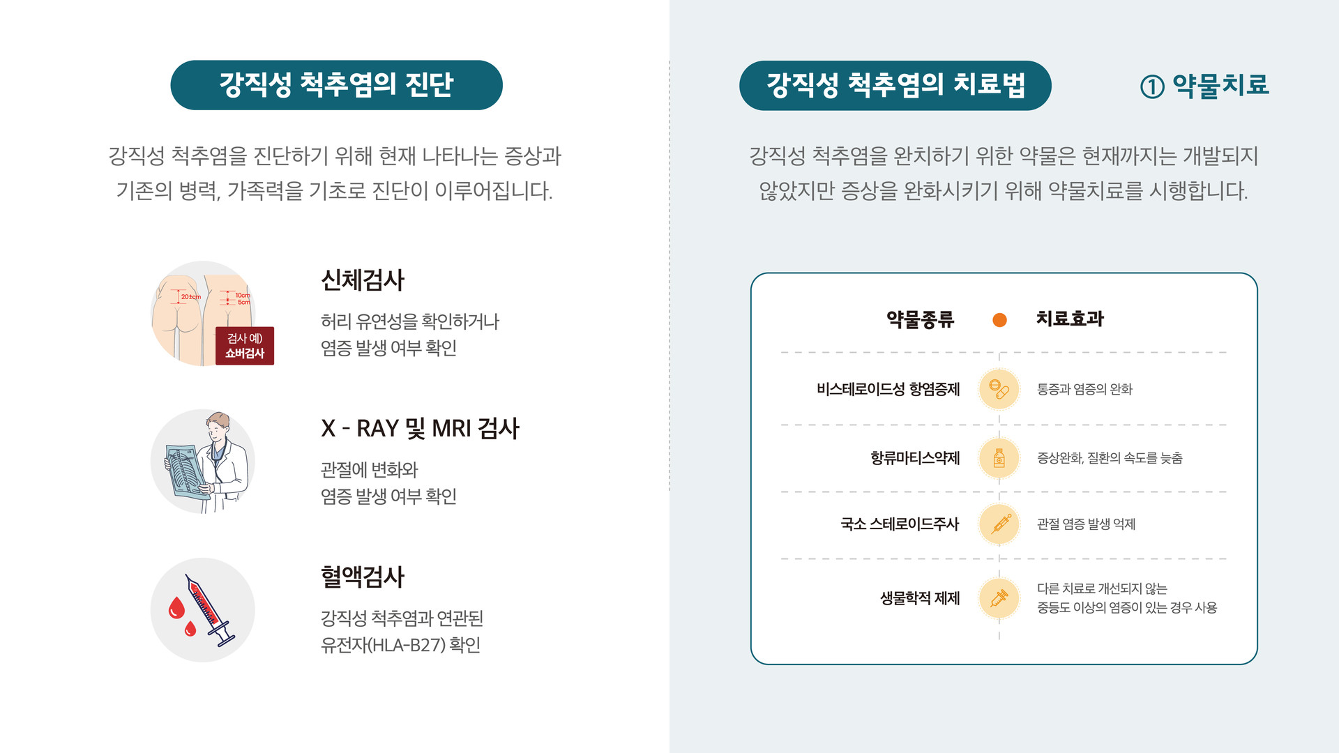 강직성척추염 진단 치료 산정특례 HLA-B27 