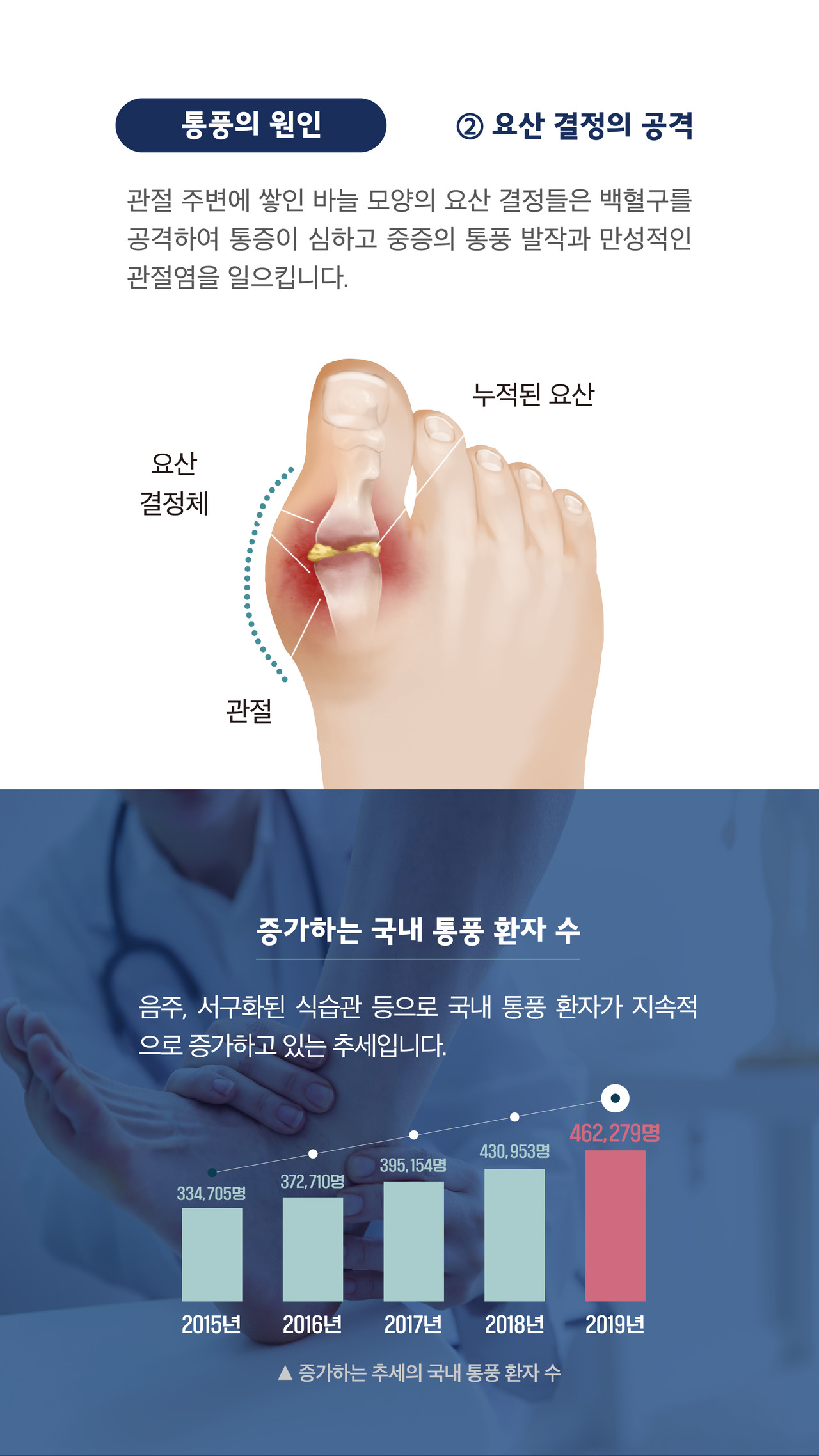 통풍 요산결정 만성관절염 엄지발가락 통증 