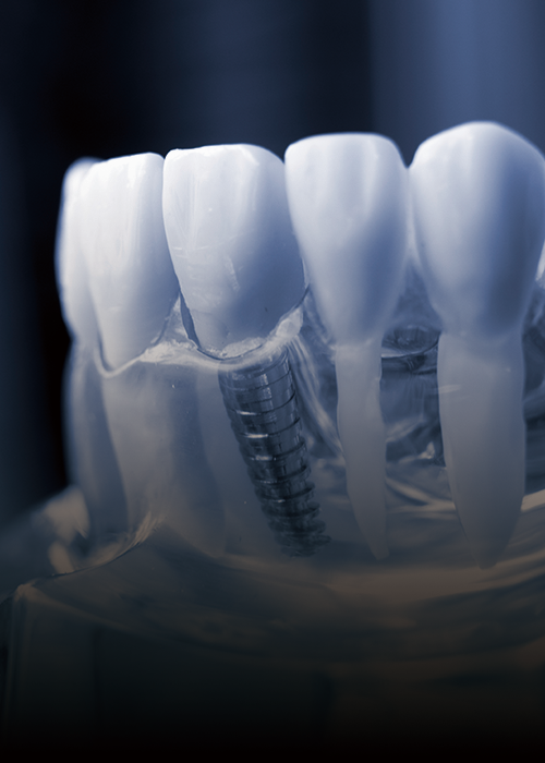 <p><strong><span style="font-size: 36px; letter-spacing: -1px;">임플란트 클리닉</span></strong></p>  <p><span style="letter-spacing: -1px;"><span style="font-size: 18px;">당일에 바로 끝낼 수 있는 고퀄리티 임플란트</span></span></p>