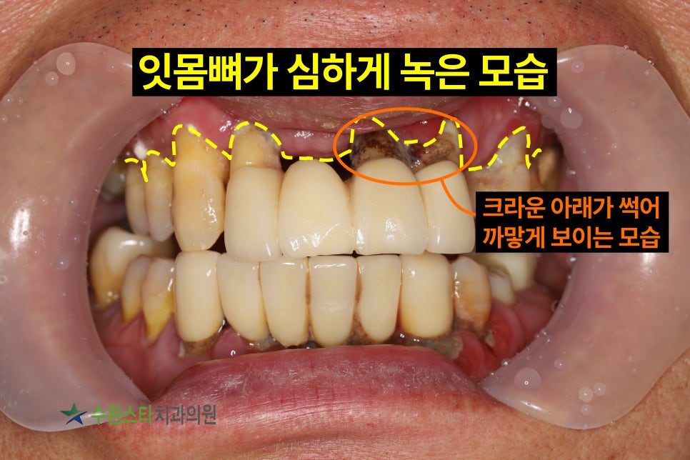 내원 시 구강 내부, 50대 남성 (2025.4 촬영)