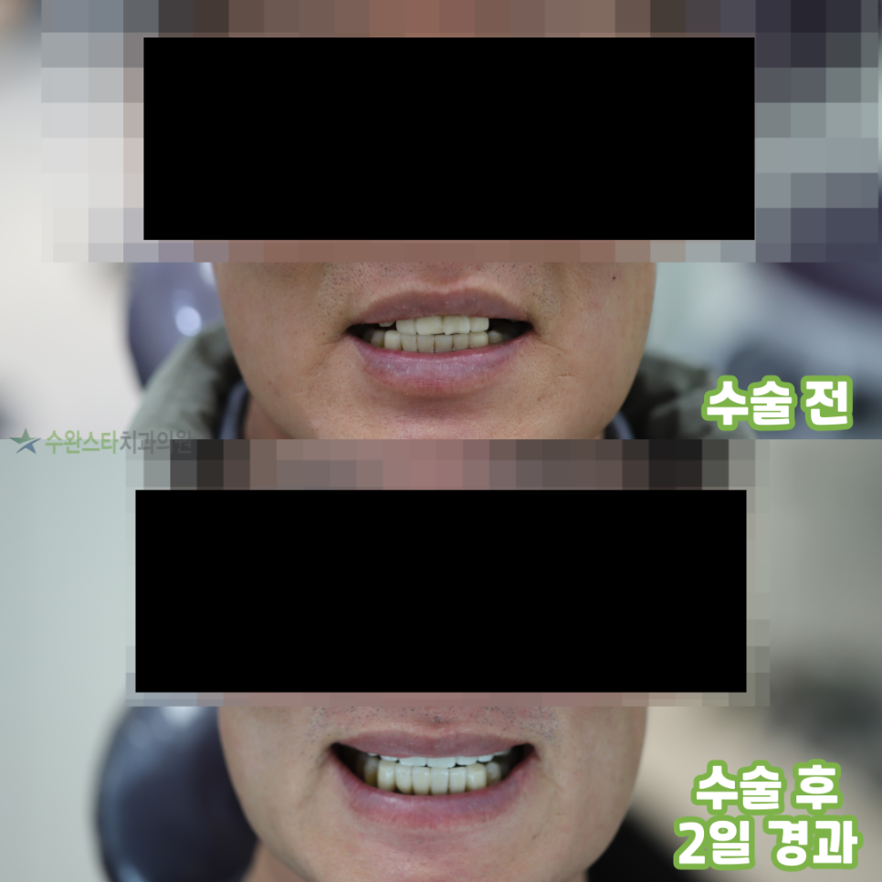 수술 전 수술 후 2일 경과, 50대 남성 (2025.4촬영)