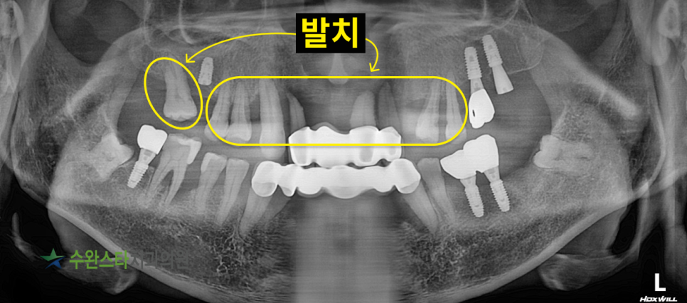 내원 시 파노라마, (50대 남성, 2025.4 촬영)