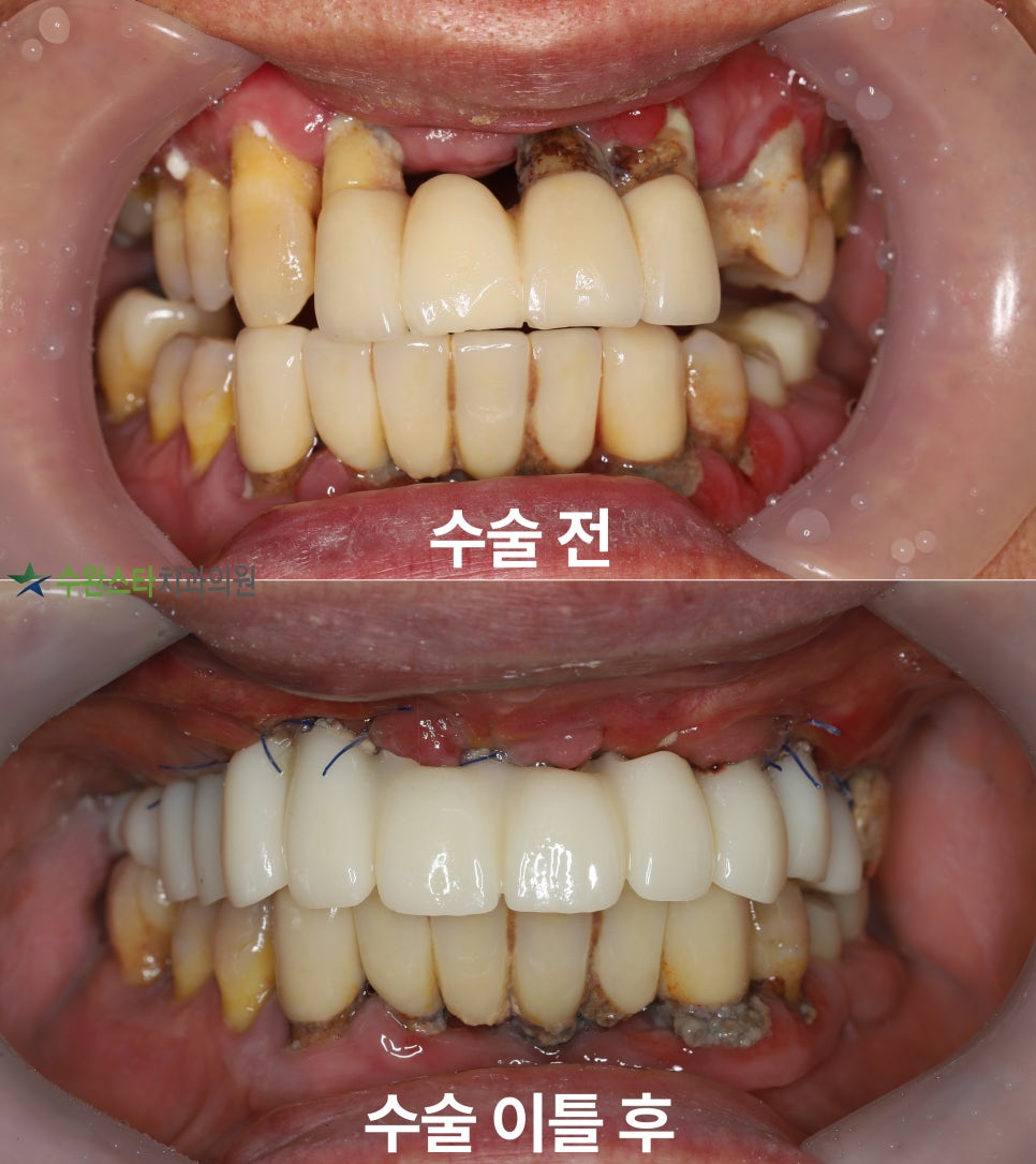 수술 전 / 수술 2일 후 구강 내부, 50대 남성 (2025.4촬영)