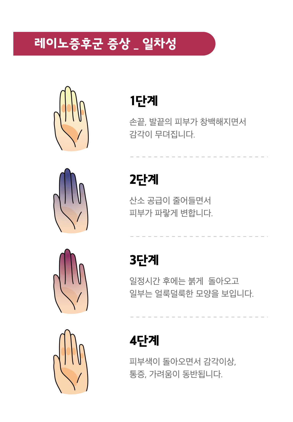 레이노증후군 손가락색 얼룩덜룩 