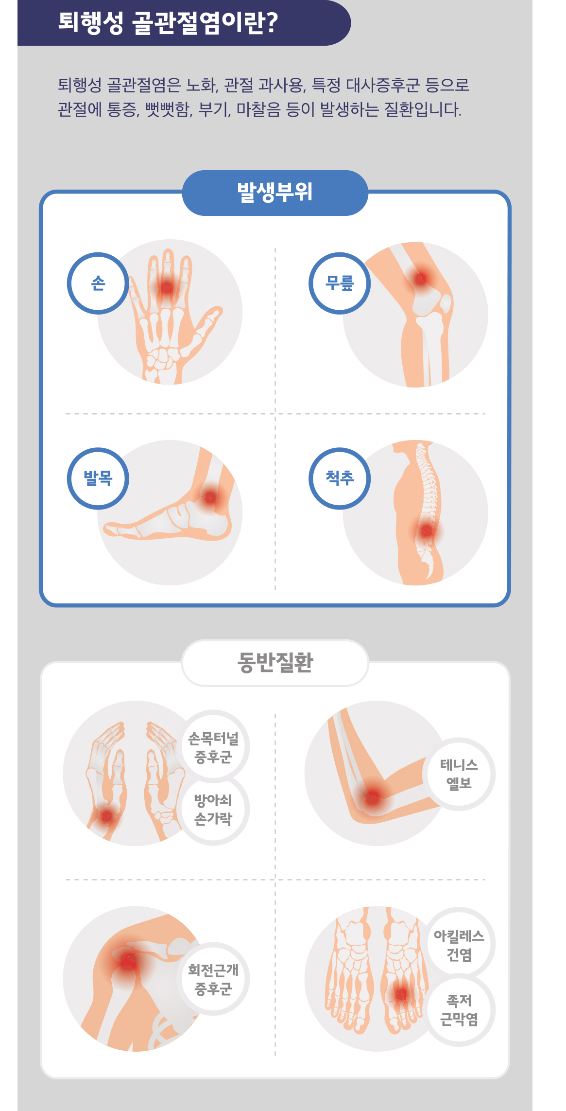 골관절염 퇴행성관절염 손목터널증후군 방아쇠손가락 테니스엘보 회전근개증후군 아킬레스건염 족저근막염