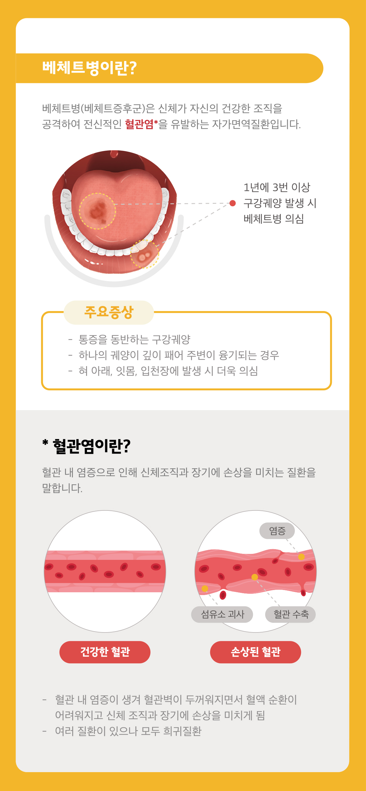 베체트 구강궤양 혈관염 