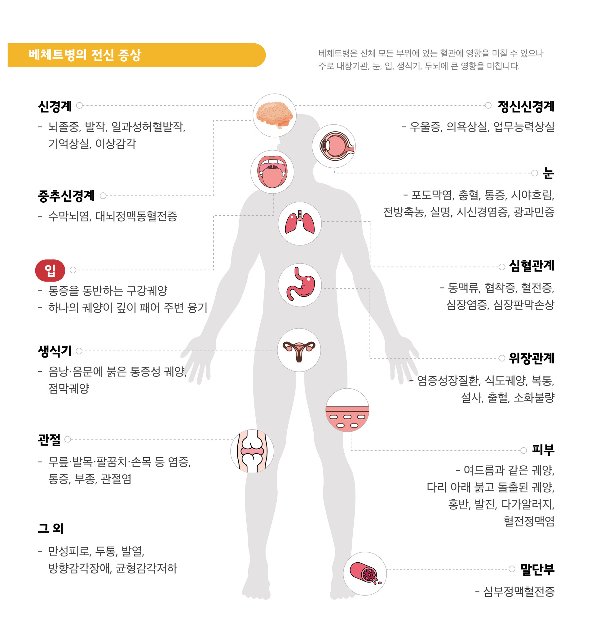 베체트증상 수막뇌염 대뇌정맥동혈전증 구강궤양 생식기궤양 관절염 포도막염 심장판막손상 다가알러지 