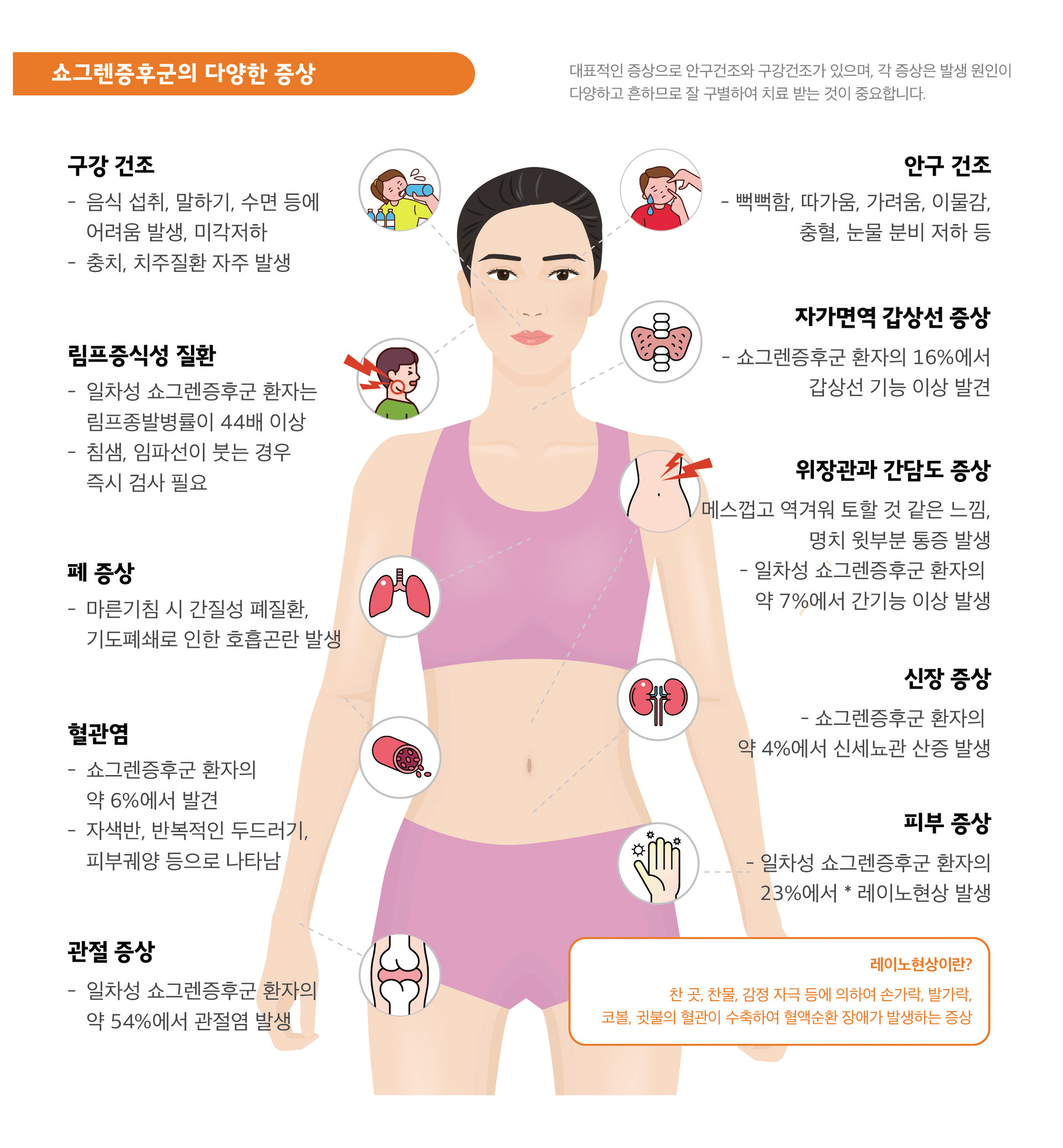 쇼그렌증후군증상 건조증 림프증식성 갑상선 레이노현상 