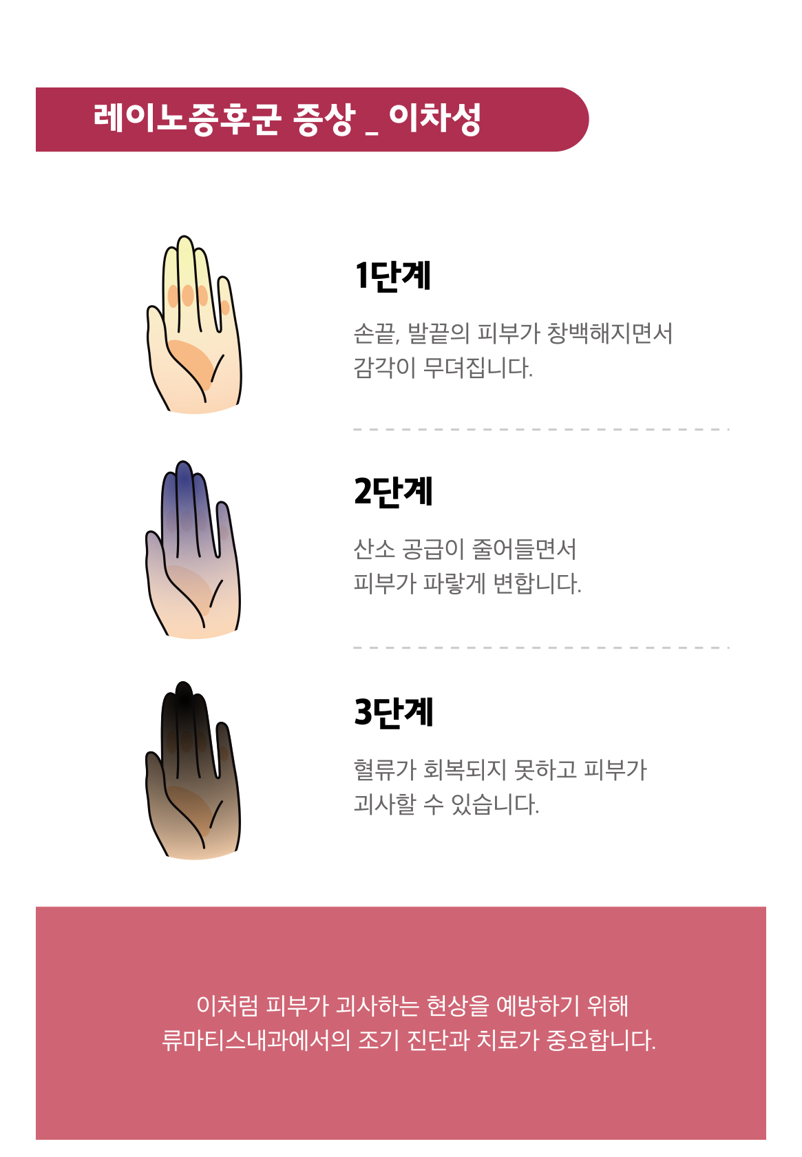 레이노증후군 이차성레이노 손가락괴사 