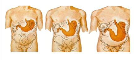 위가 커지면서 아래로 쳐지면, 식도괄약근도 확장되어서 닫히지 않음