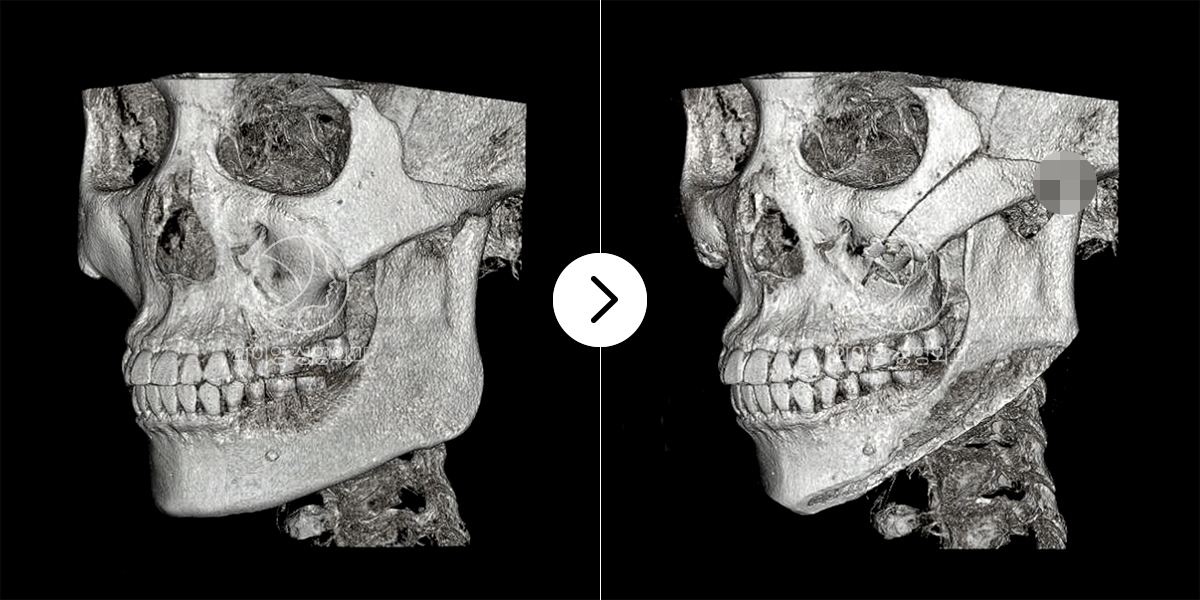 Before & After<br>confirmation with 3D-CT scan