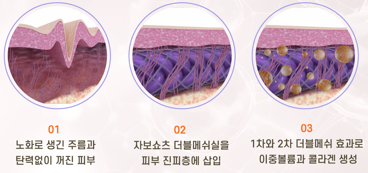 원주피부과 원더스의원 자보쇼츠는 노화로 생긴 주름과 탄력없이 꺼진피부에 이중볼륨, 콜라겐을 생성해줍니다.