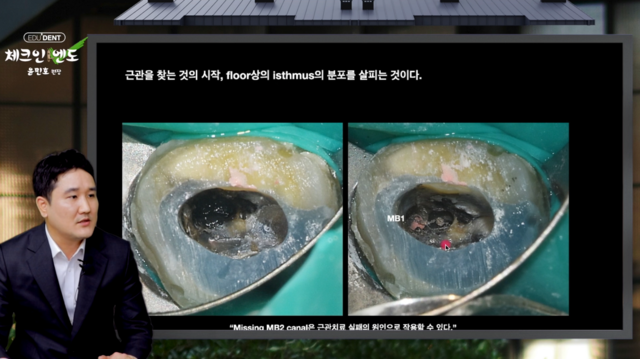 하방 분지 근관, 일관된 삽입 Path로 끝까지 간다