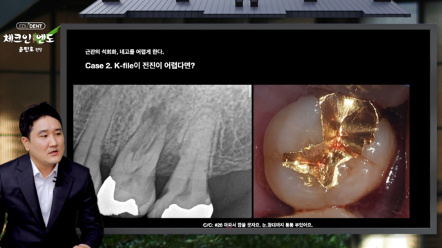 석회화된 근관, 네고의 함정을 파헤치다