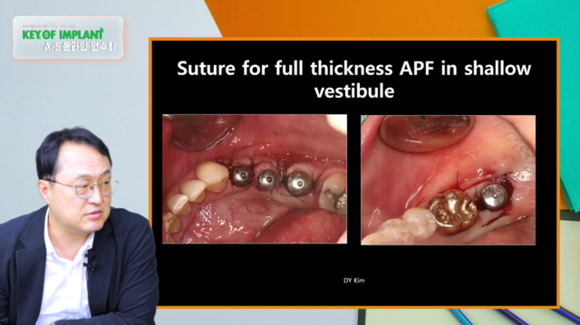 Methods of widening of Keratinized Gingiva