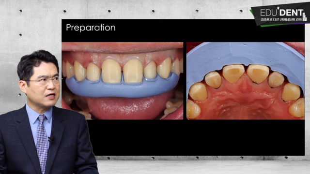 라미네이트 - 인접면 삭제