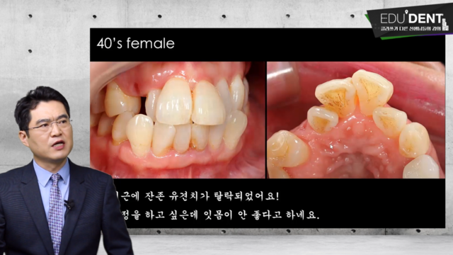 실패하지 않는 라미네이트 임상과정