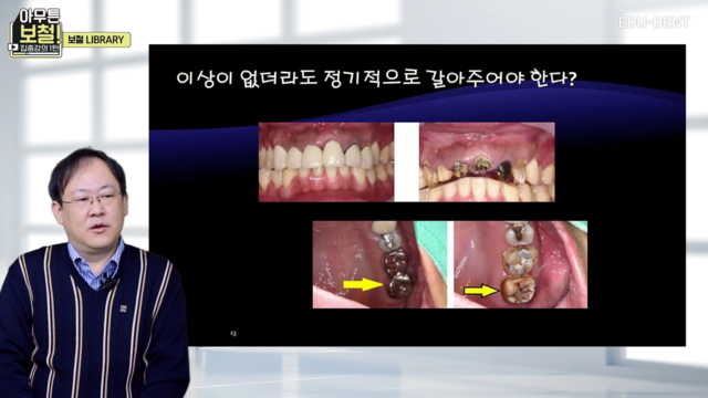 Biomechanics - 구치부 Splinting의 전략