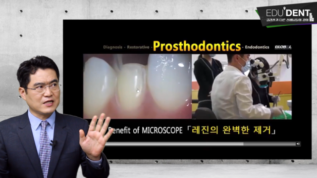 라미네이트 임시치아 제작법