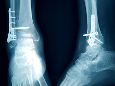 인공관절 치환술