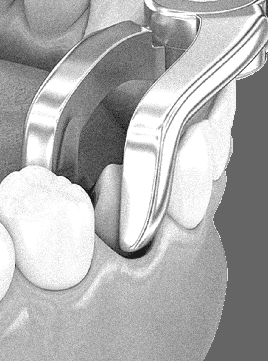 은계지구-클리어치과-발치치료-발치치료대상