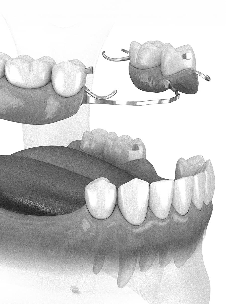 은계지구-클리어치과-틀니치료-부분틀니치료대상