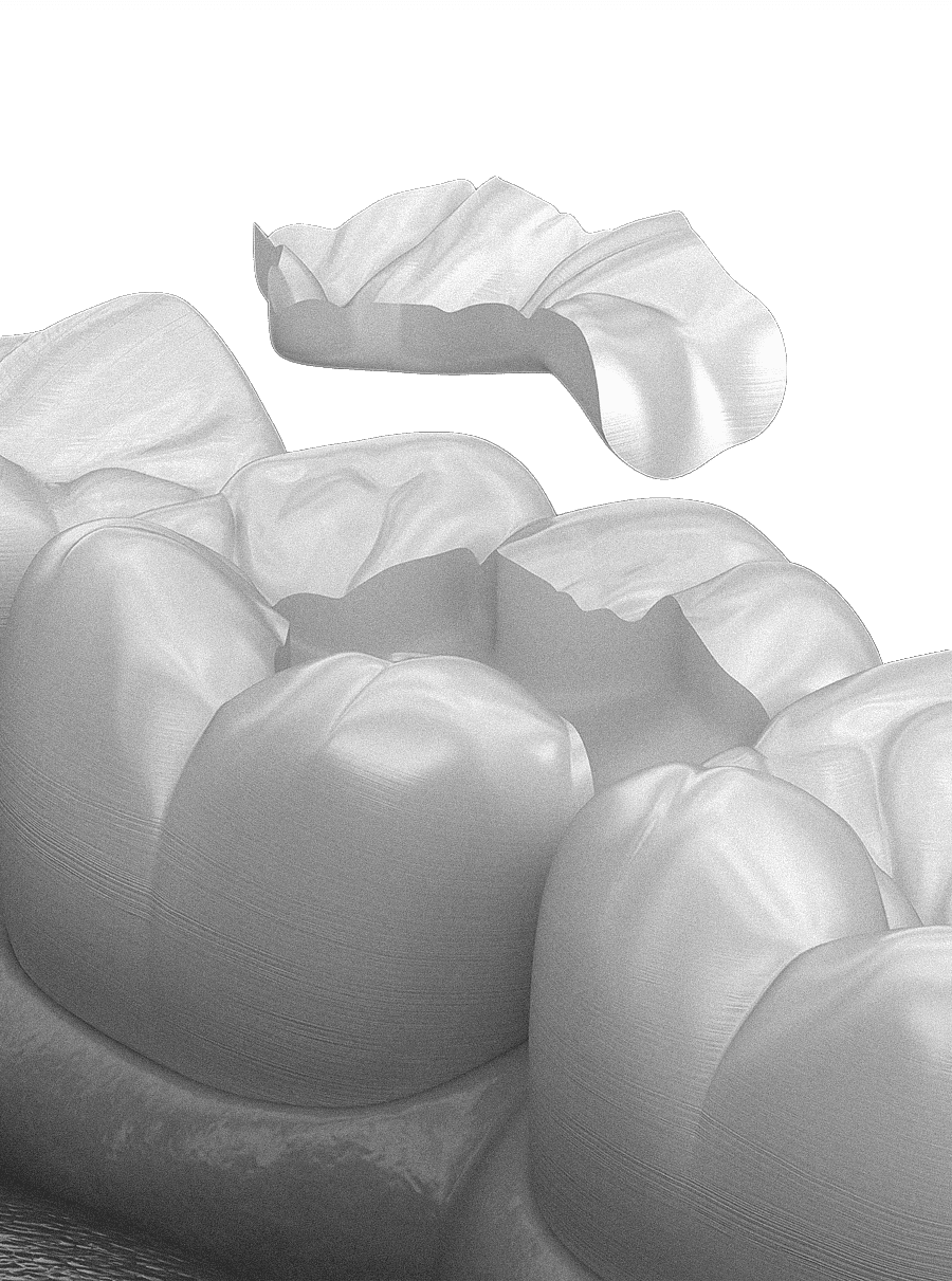 은계지구-클리어치과-인레이치료-인레이치료대상