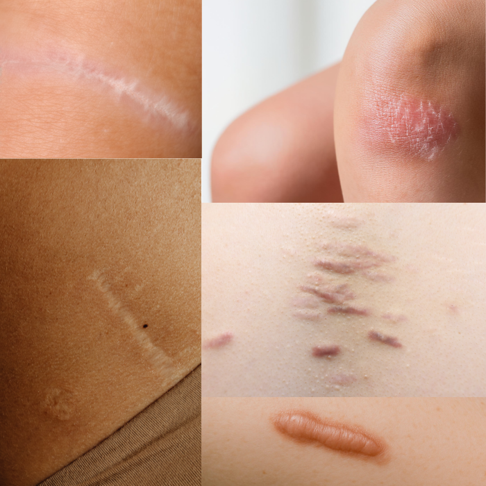 화상·여드름·수술·이식 흉터까지! 최신 레이저로 흉터를 평평하게, 피부자신감을 되찾으세요. 원주원더스피부과 흉터치료