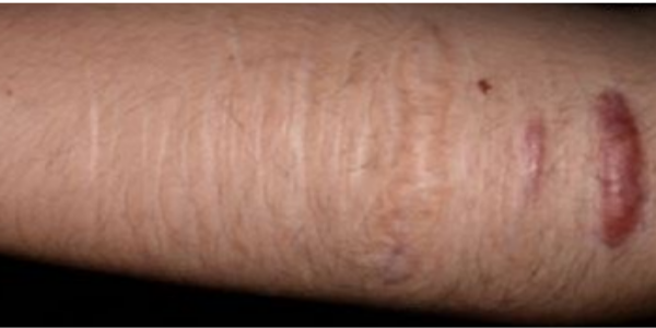 자해흔:흉터유형에 따른 흉터치료 원주 원더스피부과