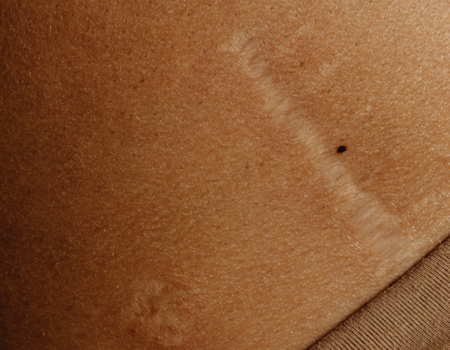 수술, 시술후흉터:흉터유형에 따른 흉터치료 원주 원더스피부과