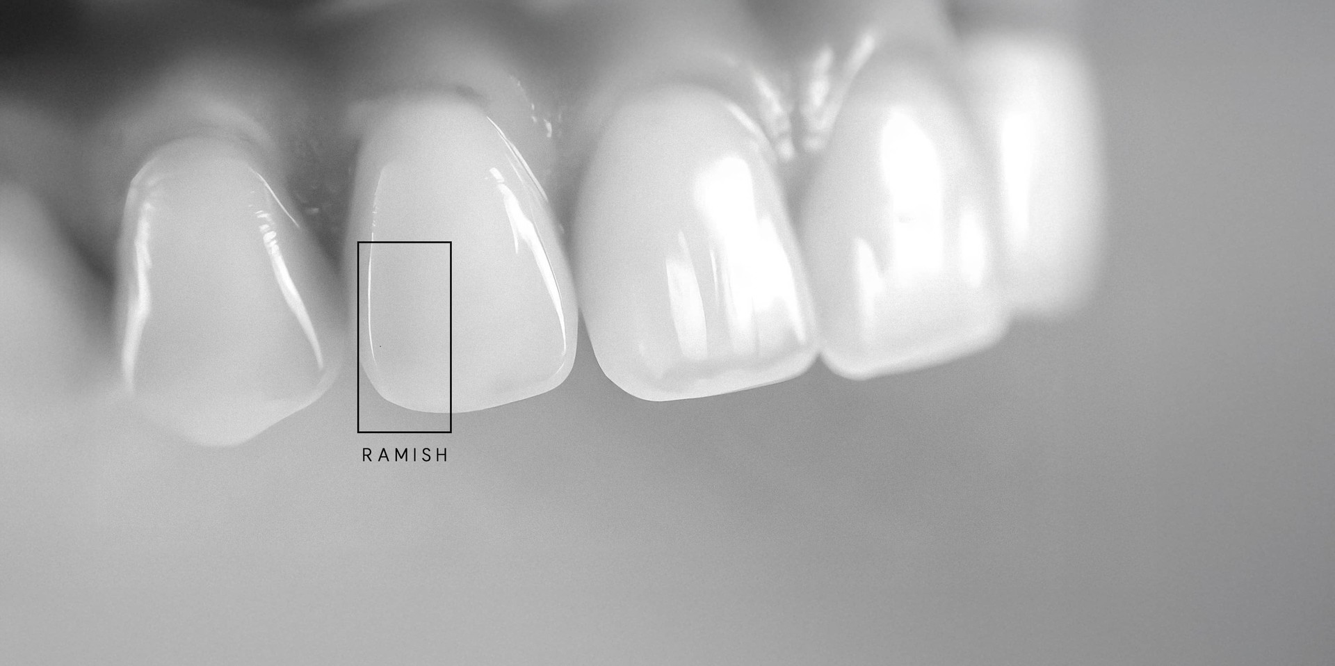 은계지구-클리어치과-무삭제라미쉬-치료대상