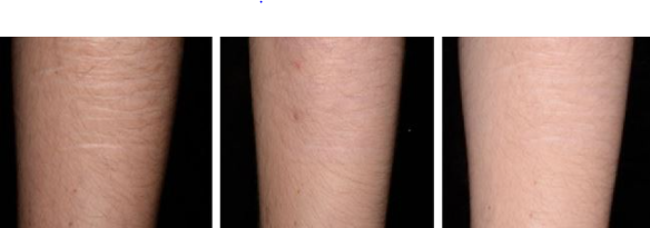 자해흔 치료 논문사진1