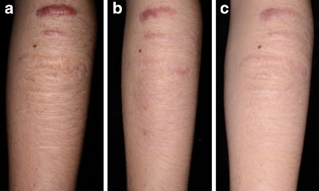 자해흔 치료 논문사진2