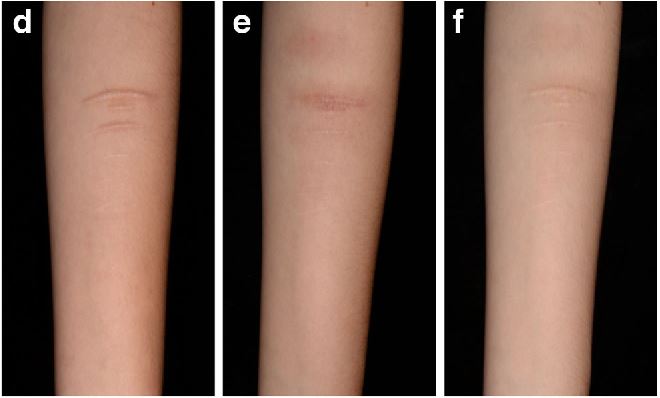 자해흔 치료 논문사진3
