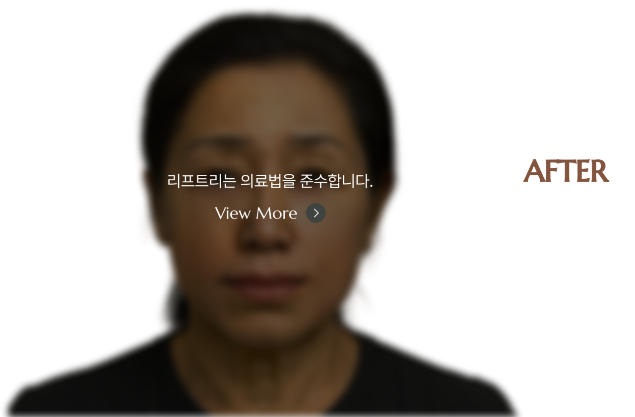 after - 부산 서면 리프트리 성형외과