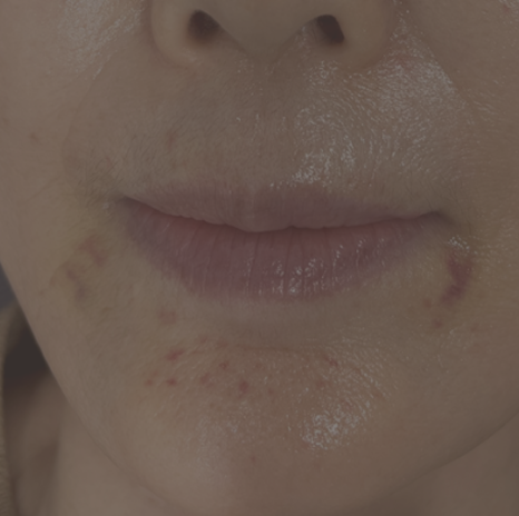 레이저로 멍을 하루만에 빼드립니다?