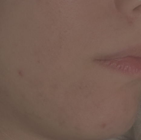 반복되는 턱 여드름 치료 방법은?